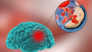 enfermedades cerebrovasculares y sistema auditivo